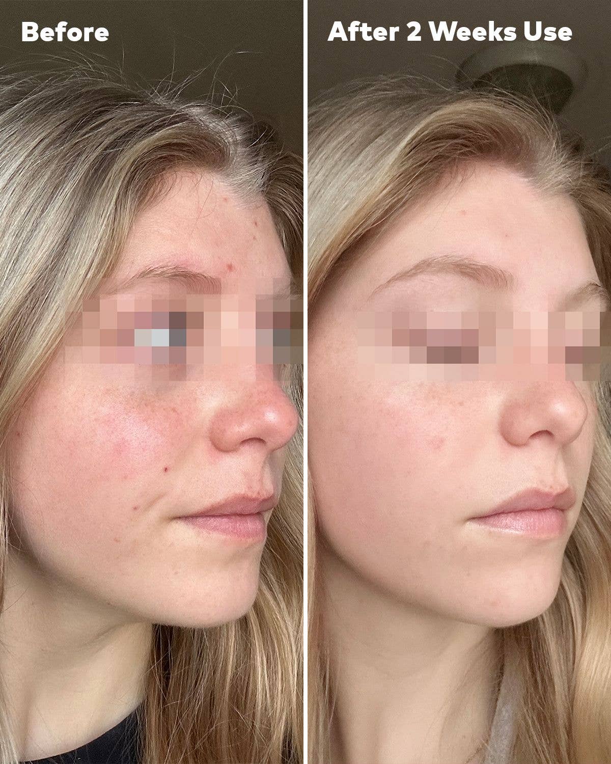 Silver Infused 7-Day Set | Designed for Blemish-Prone Skin