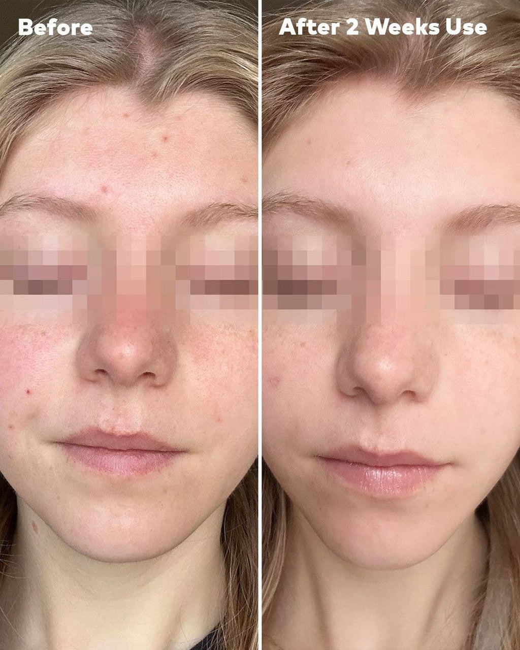 Silver Infused 7-Day Set | Designed for Blemish-Prone Skin